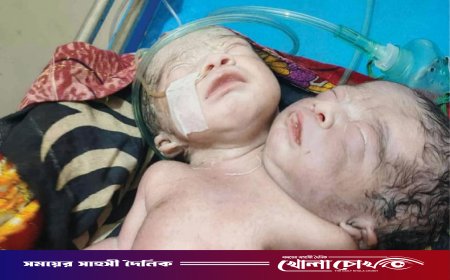 পিরোজপুরে দুই মাথা ও এক দেহবিশিষ্ট বিরল শিশুর জন্ম