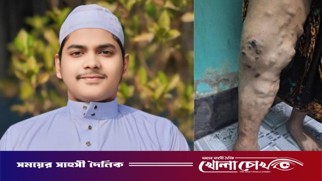 ব্রাহ্মণবাড়িয়ায় বিরল রোগে আক্রান্ত মাদরাসা ছাত্র নাজমুল