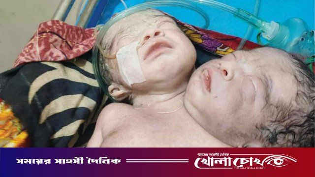 পিরোজপুরে দুই মাথা ও এক দেহবিশিষ্ট বিরল শিশুর জন্ম