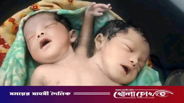 নওগাঁয় দুই মাথা ও তিন হাতওয়ালা শিশুর জন্ম, এক ঘণ্টার মধ্যেই মৃত্যুর হার