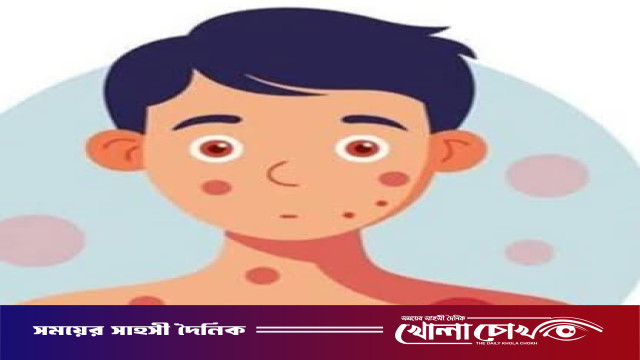 ফরিদপুর জেলায় হাম সন্দেহভাজন রোগীর সংখ্যা ২১০, গত ২৪ ঘণ্টায় নতুন ১২ জন শনাক্ত