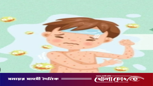 ফরিদপুরে গত ২৪ ঘণ্টায় নতুন ২৩টি হাম সন্দেহভাজন রোগী শনাক্ত