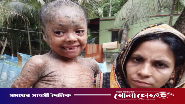 নাজিরপুরে বিরল চর্মরোগে আক্রান্ত ছোট্ট তানিয়াকে বাঁচাতে দরকার সবার সহানুভূতি