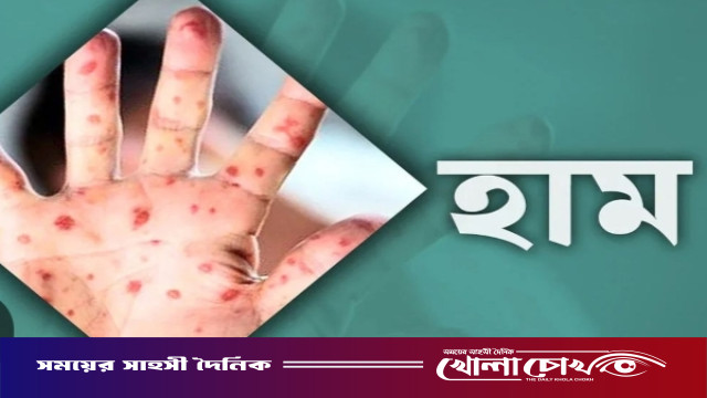 ফরিদপুরে হামের প্রকোপ বৃদ্ধি, একদিনে নতুন শনাক্ত ৫৪ জন