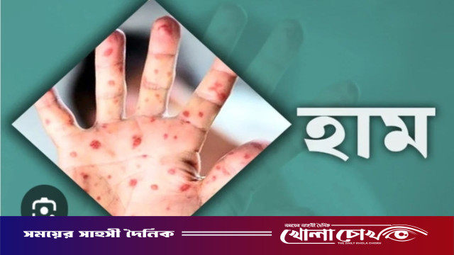 ফরিদপুরে হামের উপসর্গ নিয়ে ‌ আরেক শিশুর মৃত্যু