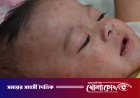 ফরিদপুরে ২৪ ঘণ্টায় আরও ৪০ জনের হাম শনাক্ত, চিকিৎসাধীন ৮৪