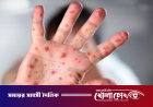 হাম উপসর্গে একদিনেই ৯ জনের মৃত্যু