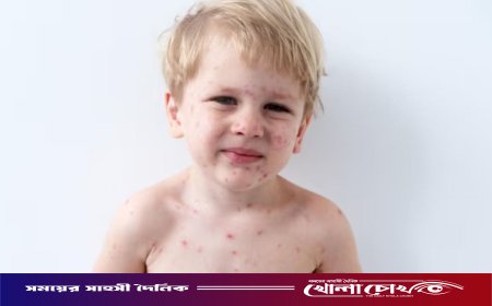 ফরিদপুরে ২৪ ঘণ্টায় আরও ৪৩ জনের হাম শনাক্ত, সুস্থ হয়েছেন ৫৮ জন
