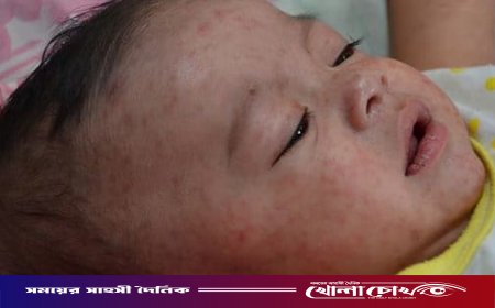 ফরিদপুরে ২৪ ঘণ্টায় আরও ৪০ জনের হাম শনাক্ত, চিকিৎসাধীন ৮৪