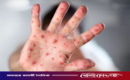 হাম উপসর্গে একদিনেই ৯ জনের মৃত্যু