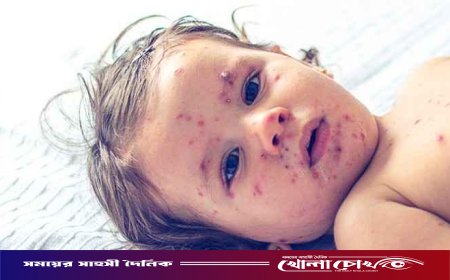 ফরিদপুরে ২৪ ঘণ্টায় নতুন ৩৬ জনের হাম শনাক্ত, মোট আক্রান্ত ছাড়াল ৬ হাজার