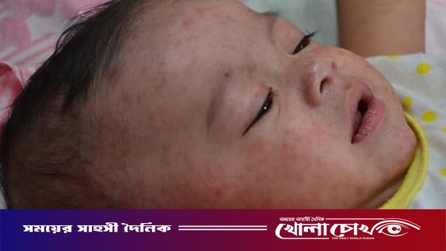 ফরিদপুরে ২৪ ঘণ্টায় আরও ৪০ জনের হাম শনাক্ত, চিকিৎসাধীন ৮৪