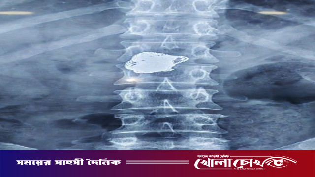 নোয়াখালীতে রোগী সেজে হাসপাতালে চেইন চুরি, এক্স-রেতে পেটে মিলল সোনা