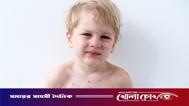 ফরিদপুরে ২৪ ঘণ্টায় আরও ৪৩ জনের হাম শনাক্ত, সুস্থ হয়েছেন ৫৮ জন