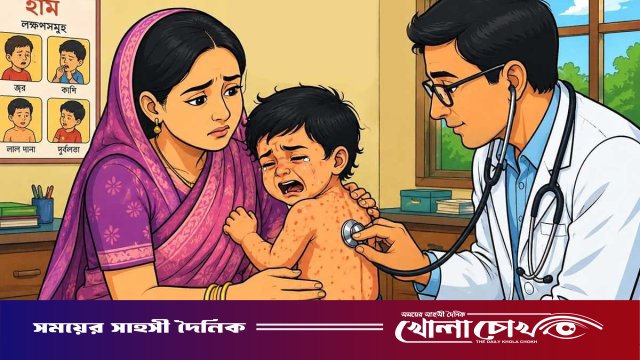 ফরিদপুরে ২৪ ঘণ্টায় নতুন ৪৪ জনের হাম শনাক্ত, হাসপাতালে ভর্তি ৯৩