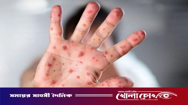 হাম উপসর্গে একদিনেই ৯ জনের মৃত্যু