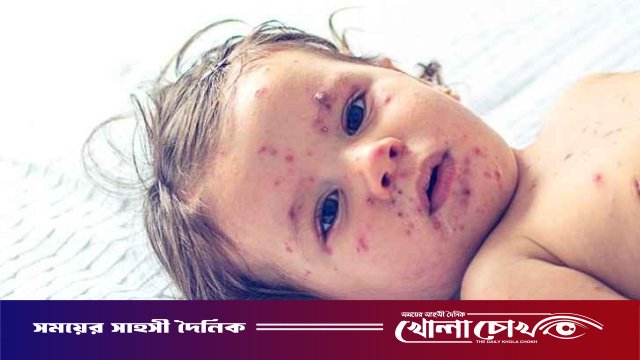 ফরিদপুরে ২৪ ঘণ্টায় নতুন ৩৬ জনের হাম শনাক্ত, মোট আক্রান্ত ছাড়াল ৬ হাজার