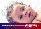 ফরিদপুরে ২৪ ঘণ্টায় হামে আক্রান্ত আরও ২৩, হাসপাতালে ভর্তি ৮৯ জন