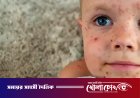 ফরিদপুরে হাম সন্দেহে নতুন ২৮ রোগী হাসপাতালে ভর্তি, চিকিৎসাধীন ৮৫