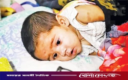 ফরিদপুরে ২৪ ঘণ্টায় হাম সন্দেহে হাসপাতালে ভর্তি ২৪, নতুন মৃত্যু নেই