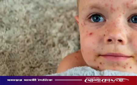 ফরিদপুরে হাম সন্দেহে নতুন ২৮ রোগী হাসপাতালে ভর্তি, চিকিৎসাধীন ৮৫