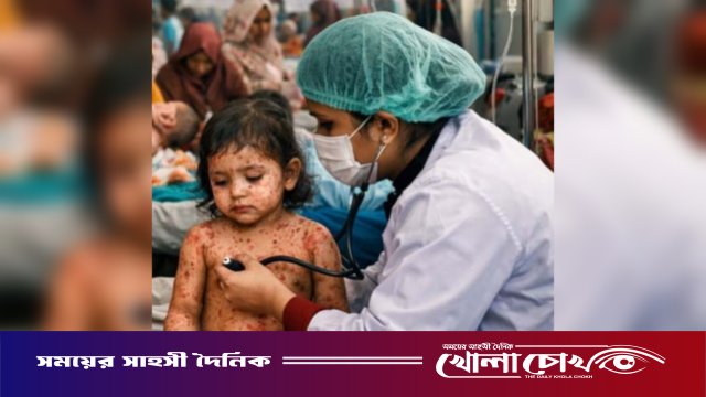 ফরিদপুরে ২৪ ঘণ্টায় হামের সন্দেহভাজন ৩৪ রোগী হাসপাতালে ভর্তি, চিকিৎসাধীন ১২৭