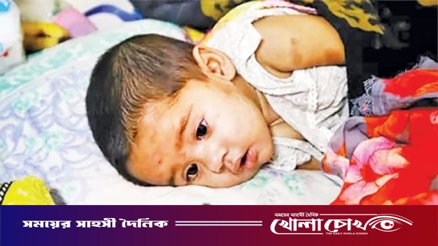 ফরিদপুরে ২৪ ঘণ্টায় হাম সন্দেহে হাসপাতালে ভর্তি ২৪, নতুন মৃত্যু নেই